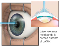How LASIK Works